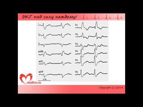 Видео: Урок 7. Видеокурс "ЭКГ под силу каждому".