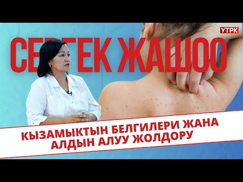 Видео: Кызамыктын белгилери жана алдын алуу жолдору // Сергек жашоо