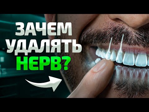Видео: Всё, что нужно знать про удаление зубного нерва. Стоит ли удалять?