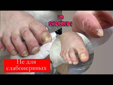 Видео: 🙈А есть ли грибок ? / Педикюр //Проблема изменения ногтей / Подология