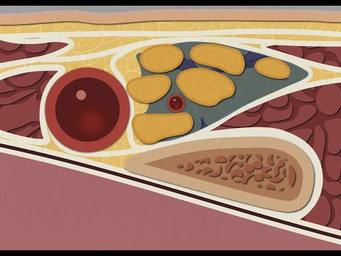 Видео: Надключичная блокада ("Спинальная анестезия руки") под УЗИ | Техника "Corner Pocket"