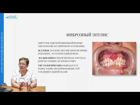 Видео: ПАРОДОНТОМЫ