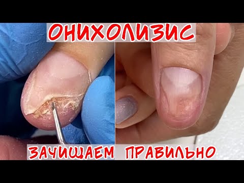 Видео: Как зачистить онихолизис качественно? Делаем плавный переход от ногтевой пластины к ложу