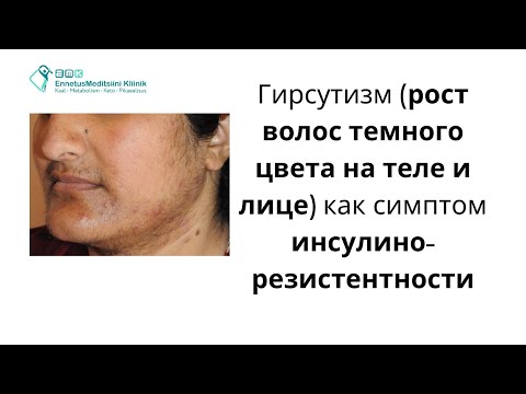 Видео: Причина роста тёмных волос на лице и теле - инсулинорезистентность | Dr sergey Saadi