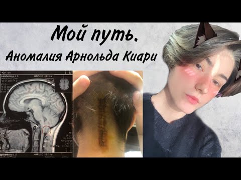 Видео: Мой путь. Аномалия Арнольда-Киари.