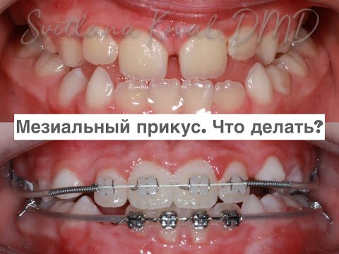 Видео: Мезиальный прикус, сужение верхней челюсти  Планирование ортодонтического лечения