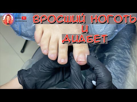 Видео: Врастание ногтевой пластины у клиента с диабетом
