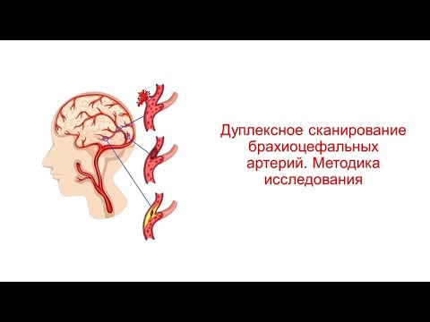 Видео: Дуплексное сканирование брахиоцефальных артерий