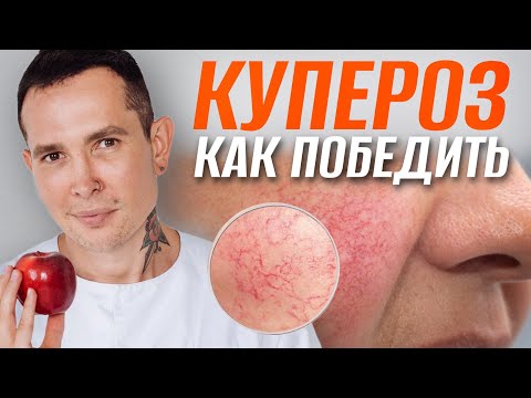 Видео: КУПЕРОЗ как победить | Полное пособие #купероз