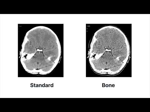 Видео: Что происходит в процессе реконструкции для создания КТ-изображения?: Физика КТ