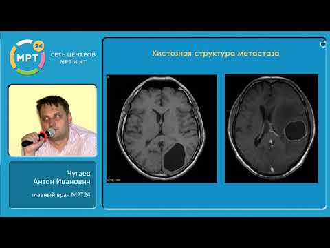 Видео: Метастатические поражения головного мозга