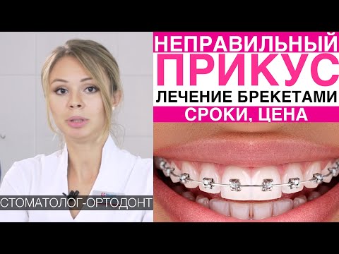 Видео: Неправильный прикус - исправление прикуса и кривых зубов брекетами, установка брекетов, срок, цена