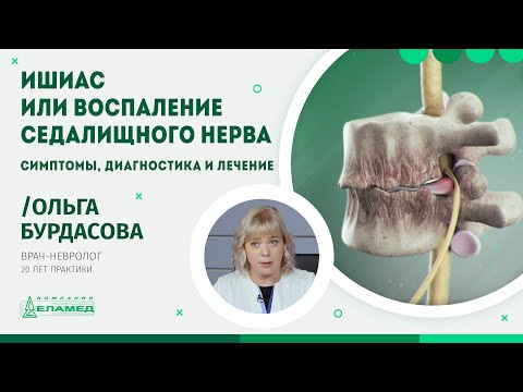 Видео: Ишиас или воспаление седалищного нерва. Симптомы, диагностика и лечение | Ольга Бурдасова