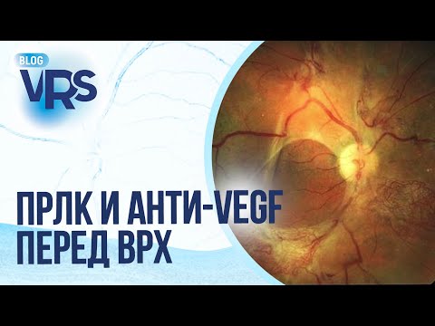 Видео: Сахарный диабет / Диабетическая ретинопатия / ПРЛК и анти-vegf перед хирургией