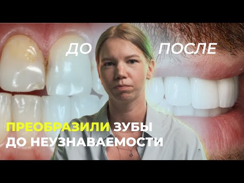 Видео: КАК ВИНИРЫ ИЗМЕНИЛИ УЛЫБКУ: КЕЙС ДО/ПОСЛЕ