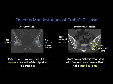 Видео: Болезнь Крона, часть 3. Внекишечные признаки