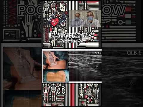 Видео: TAP, ПОДВЗДОШНО-ПОДЧРЕВНЫЙ И ПОДВЗДОШНО ПАХОВЫЙ НЕРВЫ, БЛОКАДА QLB. СЕРИЯ РЕГИОНАРНАЯ АНЕСТЕЗИЯ