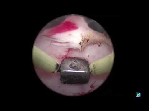 Видео: Биполярная энуклеация гиперплазии простаты - выполняет доктор Сорокин Николай Иванович