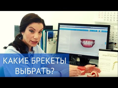 Видео: Исправление прикуса: какие брекеты выбрать?