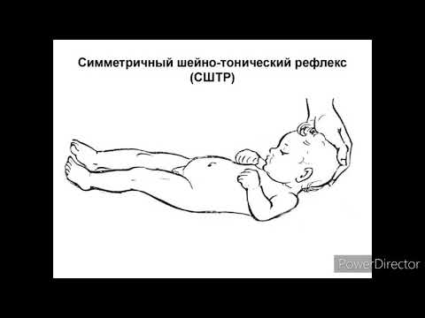 Видео: Симметричный шейно-тонический рефлекс ДЦП, нарушение речи