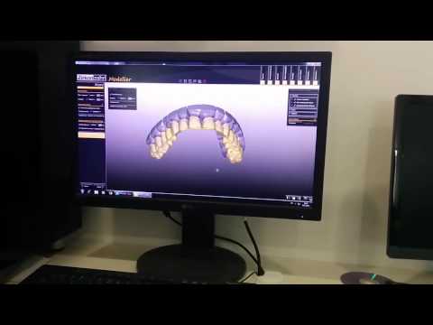 Видео: Изготовление каркаса по технологии селективного лазерного спекания. Все этапы работ.