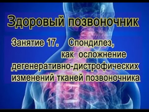 Видео: Занятие 17.    Спондилез в больном позвоночнике при ДДИ.