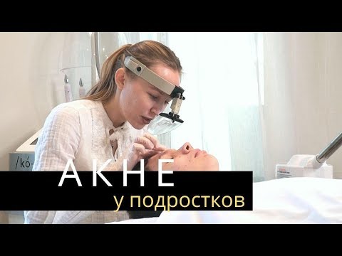 Видео: АКНЕ. Прыщи у подростков | Лечение Акне у косметолога | Anastasia Talan