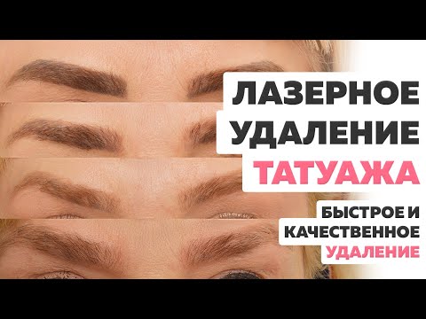 Видео: Лазерное удаление татуажа. Можно ли удалить татуаж быстро, качественно и БЕСПЛАТНО?