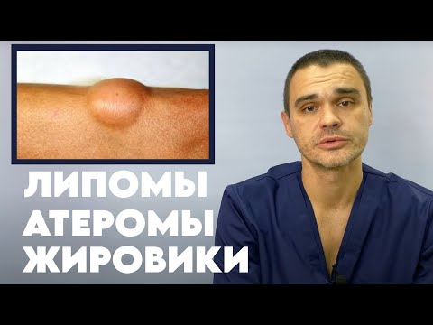 Видео: Жировики или атеромы и липомы | Как выглядят в чем отличия как их убрать?#пластическийхирург #доктор