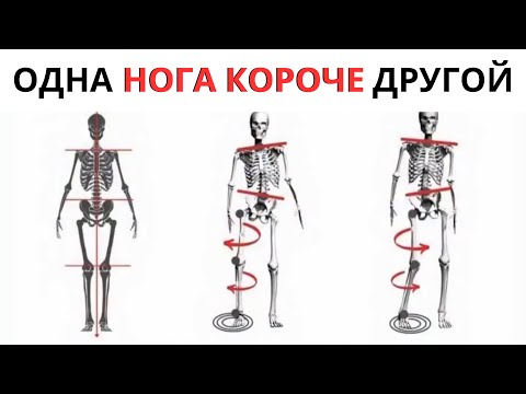 Видео: ОДНА НОГА КОРОЧЕ ДРУГОЙ, ВЕБИНАР О СКОЛИОЗЕ #yoginya_alina #сколиоз