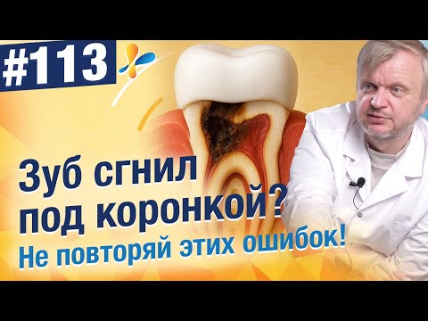 Видео: Зубы под коронкой гниют? Что делать, чтобы зуб под коронкой не разрушился?