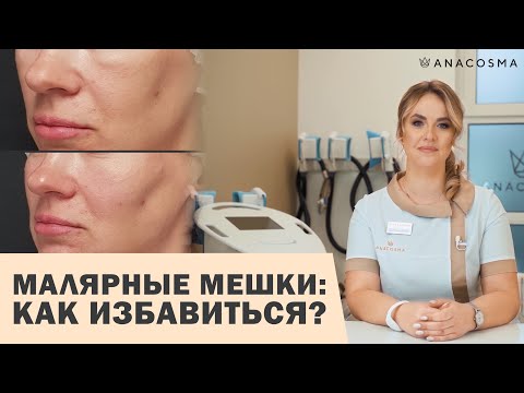 Видео: МАЛЯРНЫЕ МЕШКИ ❌ СУФЫ ПОД ГЛАЗМИ😱👉🏻 Как избавиться⁉️