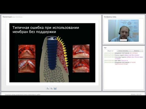 Видео: 2013 07 02 Концепция метода расщепления тонкого альвеолярного гребня  0001