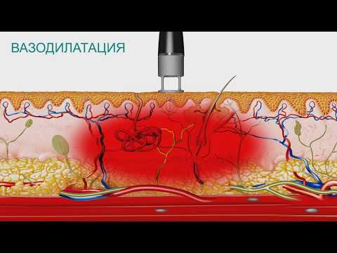 Видео: Лазер высокой интенсивности BTL 6000 HIL  Особенности технологии и медицинские эффекты