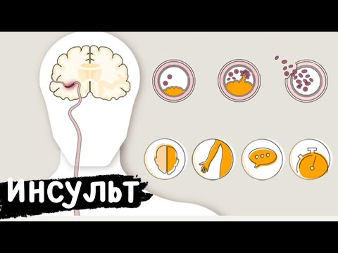 Видео: Инсульт, как нам всем его избежать? Холестерин, атеросклероз