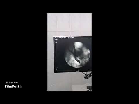 Видео: ЭПСТ,ЭРХПГ