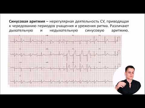 Видео: ЭКГ за 100 минут №4: Нарушения ритма на ЭКГ