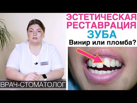 Видео: Реставрация зубов с помощью материала пломбы и керамического винира. Сколы, сломанный зуб.