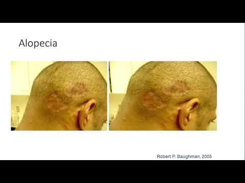 Видео: Саркоидоз2020 3