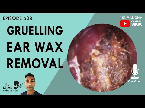 Видео: 628 - Изнурительное удаление ушной серы
