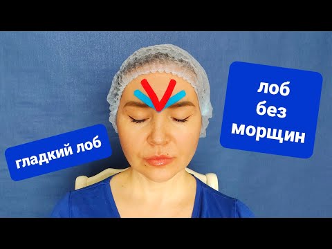Видео: Гладкий лоб при помощи тейпирования | Как тейпировать лоб