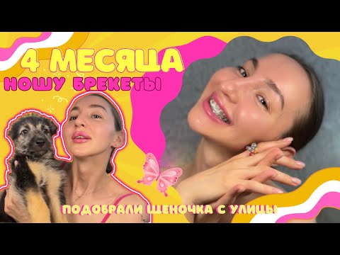 Видео: Реставрация сточенного зуба жидким композитом 🦷✨4 месяца ношу брекеты