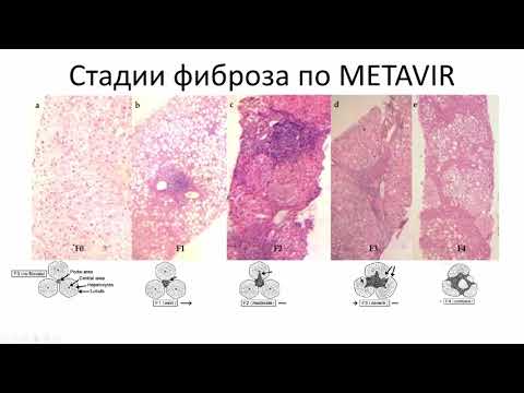 Видео: Эхосемиотика диффузных изменений печени.  Часть 1. Цирроз печени
