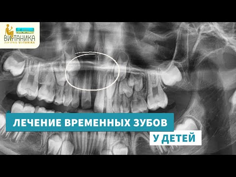 Видео: Лечение временных зубов у детей