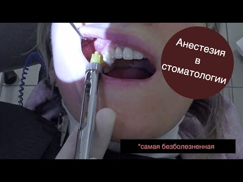 Видео: Анестезия в стоматологии. Самая безболезненная ИНФИЛЬТРАЦИОННАЯ анестезия