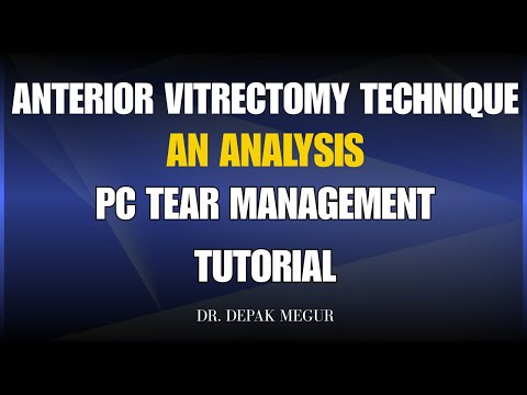 Видео: Учебное пособие по технике передней витрэктомии — разрыв ПК и стекловидное тело, рекомендации и з...