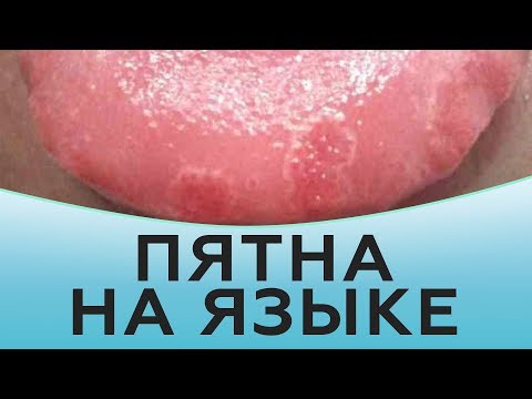 Видео: Пятна на языке