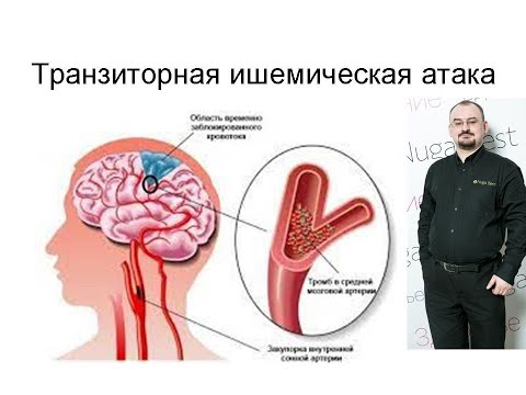 Видео: Транзиторная ишемическая атака