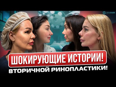 Видео: Повторная ринопластика // ШОКИРУЮЩИЕ ИСТОРИИ наших пациентов // Ринопластика в Турции.