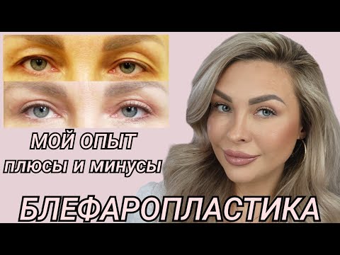 Видео: БЛЕФАРОПЛАСТИКА 👁 МОЯ ИСТОРИЯ || МОЙ ОПЫТ|| РЕАБИЛИТАЦИЯ || ПЛЮСЫ И МИНУСЫ